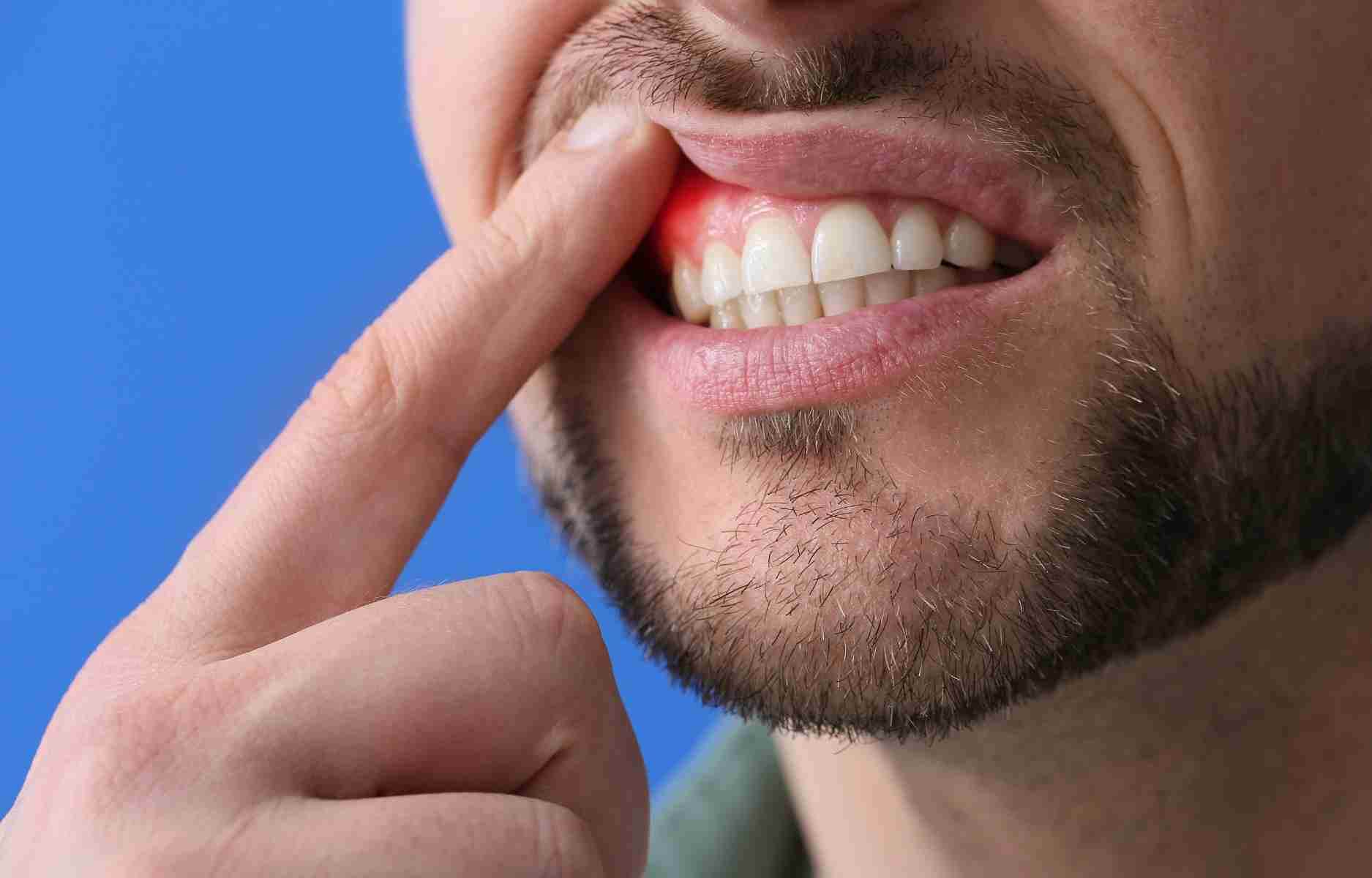 Natečene i crvene desni, krvarenje, crvenilo, i bol su simptomi paradentoze. Uz pravilnu oralnu higijenu, pasta za zube na bazi gline može pomoći u smanjenju rizika. Zdrava ishrana, izbegavanje pušenja i alkohola takođe su ključni faktori za prevenciju. Brinite o svom osmehu i oralnom zdravlju!